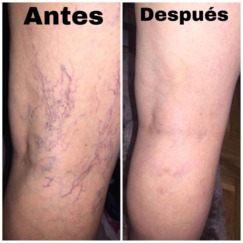 (SUPER 2X1) Spray Anti-Varices 100% Natural